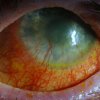 Left Eye - 24 year old male who suffered Toxic Epidermal Necrolysis Syndrome with severe Ocular involvement. Photo was taken 2 years after the initial TEN reaction